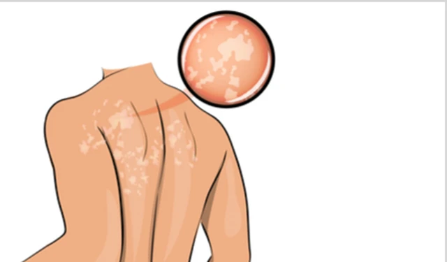 bai-viet/cach-chua-lang-ben-o-lung-hieu-qua-53113.html