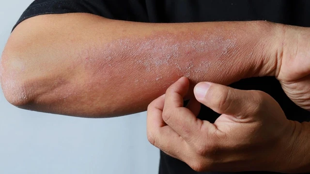 bai-viet/5-sai-lam-trong-dieu-tri-viem-da-co-dia-de-mac-phai.html