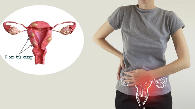 bai-viet/8-bien-chung-sau-khi-mo-u-xo-tu-cung-co-the-gap-ban-nen-biet-72598.html