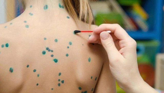 bai-viet/9-loai-thuoc-boi-thuy-dau-giup-giam-ngua-ho-tro-phuc-hoi-da-hieu-qua.html