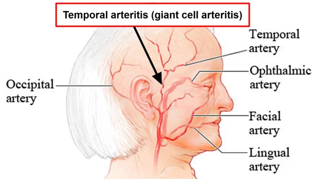 benh/benh-horton.html