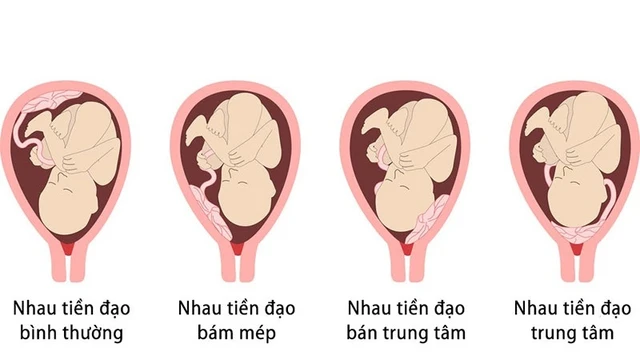bai-viet/banh-nhau-thai-la-gi-va-5-benh-ly-banh-nhau-thuong-gap.html