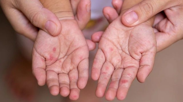 bai-viet/be-bi-tay-chan-mieng-uong-thuoc-gi-luu-y-khi-cho-be-dung-thuoc-chua-chan-tay-mieng.html