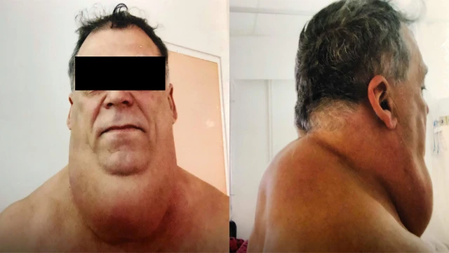 benh/benh-madelung.html