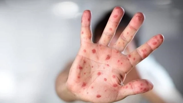 bai-viet/benh-chan-tay-mieng-cap-do-1-co-nguy-hiem-khong.html