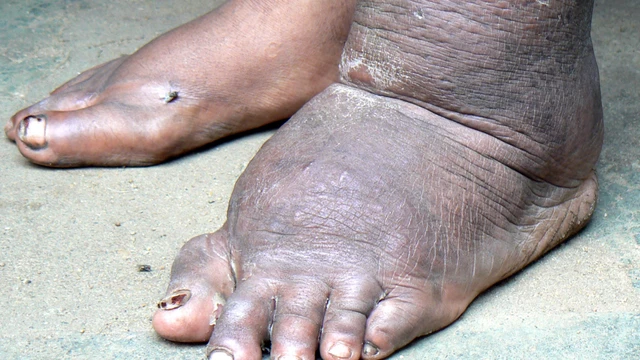 bai-viet/benh-giun-chi-bach-huyet-trieu-chung-nguyen-nhan-va-cach-phong-ngua.html