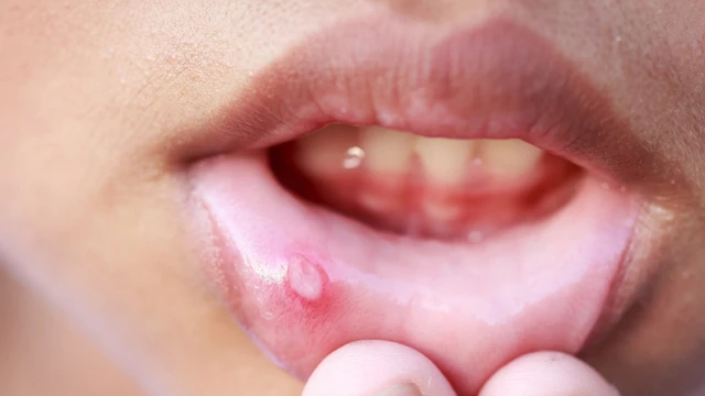 bai-viet/bi-nhiet-mieng-uong-vitamin-pp-va-b2-co-khoi-khong.html