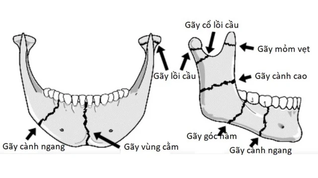 bai-viet/chi-phi-phau-thuat-gay-xuong-ham-la-bao-nhieu-ban-co-biet-chua.html
