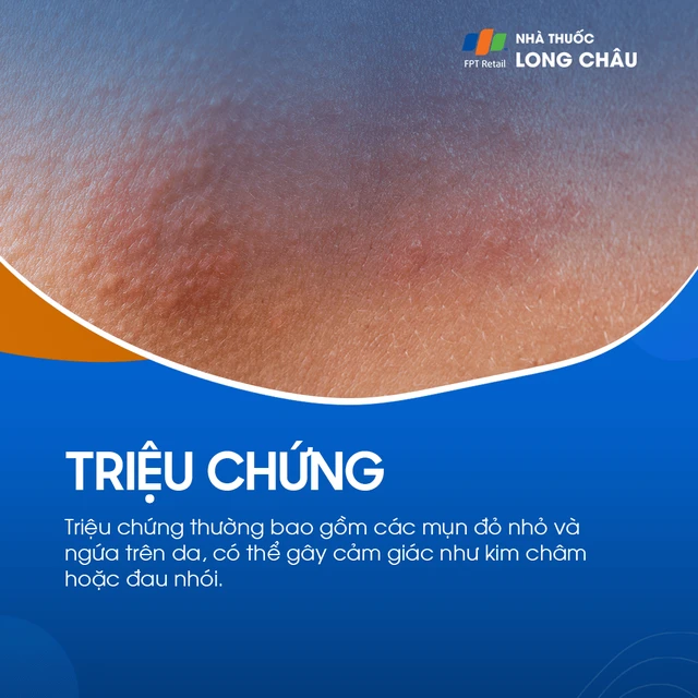Rôm sảy là gì? Nguyên nhân, dấu hiệu và cách trị
