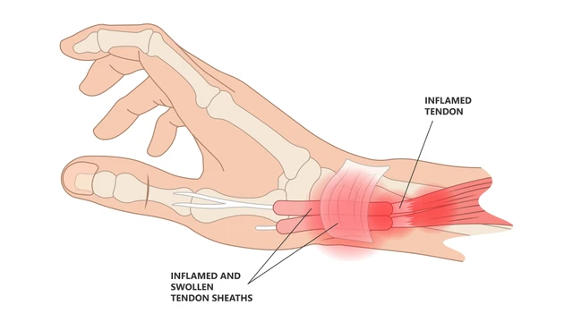benh/dau-co-tay-sau-sinh.html
