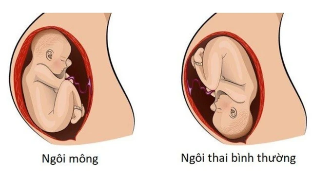 bai-viet/dau-hieu-chuyen-da-cua-ngoi-thai-nguoc-va-nhung-nguy-co-co-the-xay-ra.html