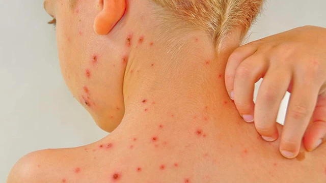 bai-viet/di-ung-thuc-pham-o-tre-la-gi-va-dau-hieu-nhan-biet.html