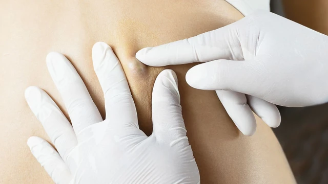 bai-viet/dieu-tri-viem-u-ba-dau-nhu-the-nao-bien-phap-ngan-ngua-viem-u-ba-dau.html