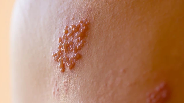 bai-viet/herpes-la-gi-nguyen-nhan-dau-hieu-nhan-biet-va-cach-dieu-tri.html