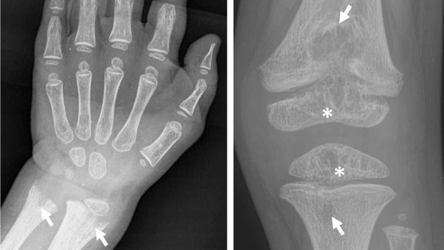 benh/benh-hypophosphatasia-hpp-bam-sinh.html