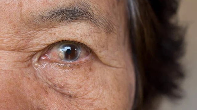 bai-viet/can-lam-gi-truoc-va-sau-khi-mo-phaco-cuom-mat.html