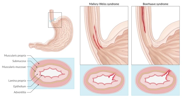 benh/hoi-chung-mallory-weiss.html