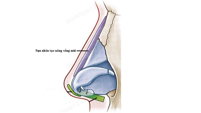 bai-viet/mui-lo-song-la-nhu-the-nao-vi-sao-xuat-hien-tinh-trang-lo-song-mui-sau-nang-mui.html