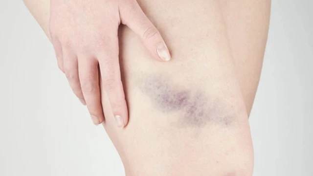 bai-viet/ngua-gai-bi-bam-tim-va-nhung-dieu-can-biet.html