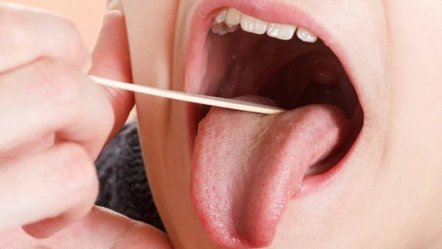 bai-viet/nguyen-nhan-va-cach-chua-viem-hong-hat-co-mu.html