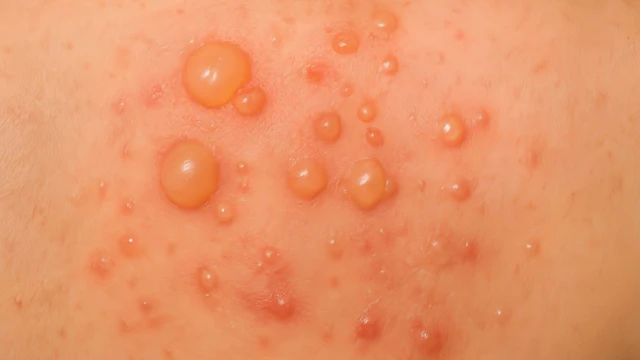 bai-viet/pemphigus-thong-thuong-nguyen-nhan-trieu-chung-cach-dieu-tri.html