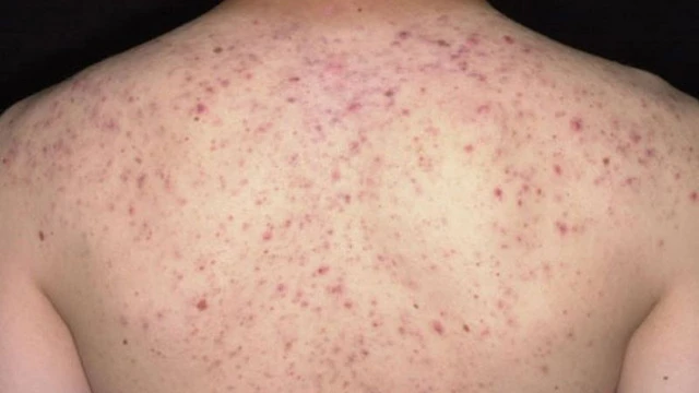 bai-viet/roi-loan-sac-to-da-la-gi-lam-cach-nao-dieu-tri-roi-loan-sac-to-da.html