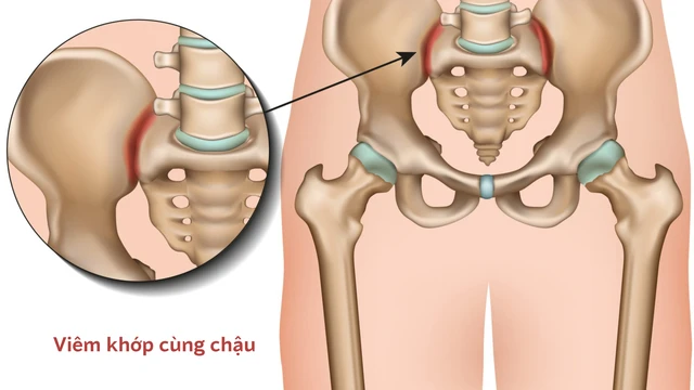 benh/viem-khop-chau.html