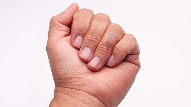 bai-viet/xo-cung-bi-khu-tru-nguyen-nhan-dau-hieu-va-cach-phong-tranh.html