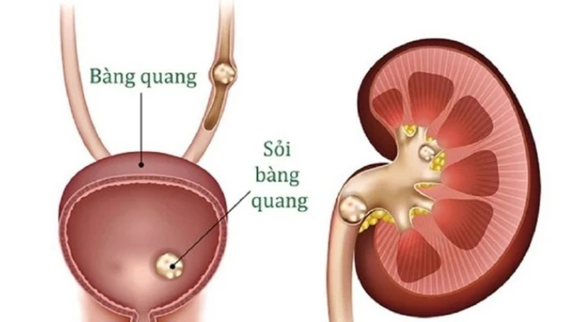 bai-viet/soi-bang-quang-uong-thuoc-gi-mau-khoi-bien-phap-phong-ngua.html