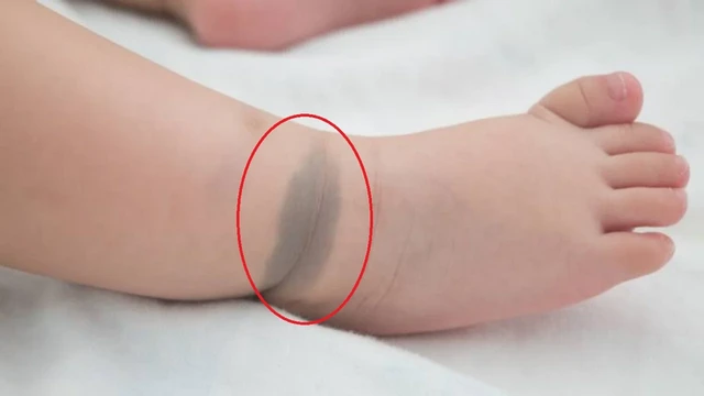 bai-viet/tinh-trang-bot-sac-to-o-da-phan-loai-nguyen-nhan-va-cach-dieu-tri.html