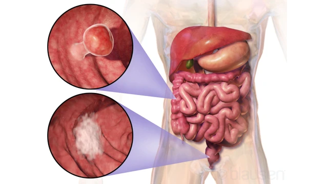 benh/ung-thu-ruot.html