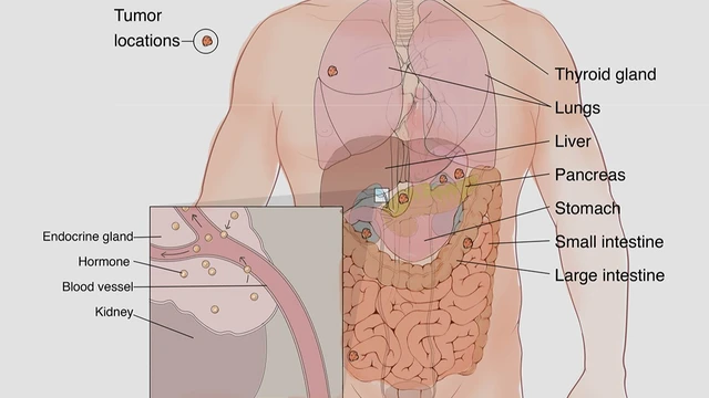 benh/u-than-kinh-noi-tiet.html