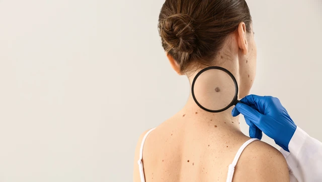 benh/u-te-bao-hac-to-287.html