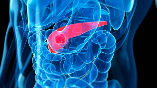 bai-viet/nhung-dieu-ban-can-biet-ve-benh-u-tuy-lanh-tinh.html