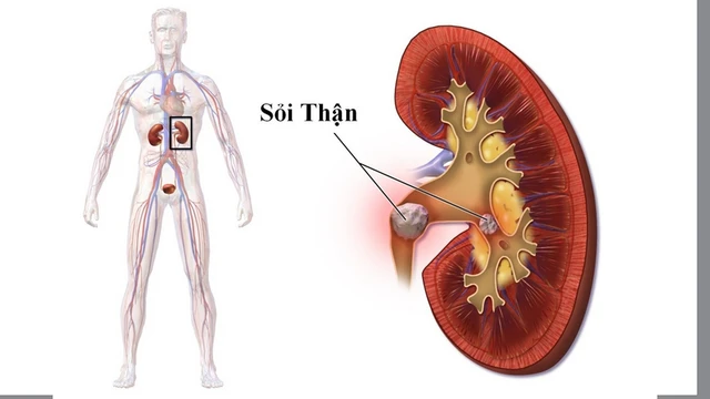 bai-viet/vi-sao-soi-than-gay-tieu-buot-huong-phong-ngua-va-dieu-tri-an-toan.html