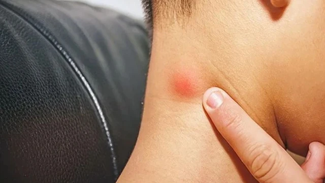 bai-viet/viem-hach-la-gi-nguyen-nhan-trieu-chung-va-phuong-phap-dieu-tri.html