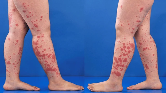 bai-viet/viem-mao-mach-di-ung-co-chua-duoc-khong.html