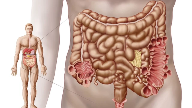 benh/viem-tui-thua-dai-trang.html