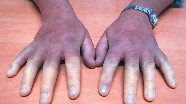 Xơ cứng bì toàn thể