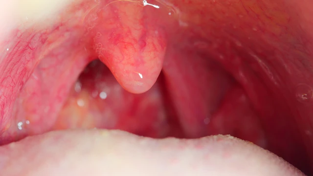 bai-viet/amidan-noi-cuc-thit-nguyen-nhan-trieu-chung-va-cach-dieu-tri.html