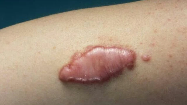 bai-viet/an-bap-co-bi-seo-loi-khong-nhung-thuc-pham-can-tranh-khi-co-vet-thuong-ho.html