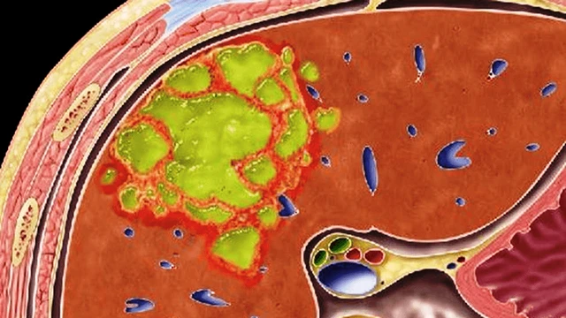 bai-viet/ap-xe-gan-do-vi-khuan-trieu-chung-va-phuong-phap-phong-ngua.html