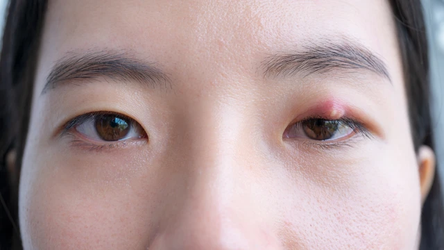 bai-viet/ap-xe-mat-la-gi-nguyen-nhan-gay-benh-va-cach-dieu-tri-hieu-qua.html