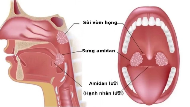 bai-viet/ap-xe-quanh-amidan-duoc-chan-doan-va-dieu-tri-nhu-the-nao.html
