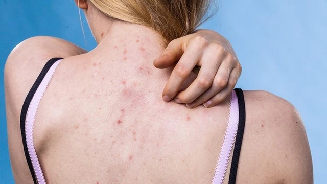 bai-viet/tham-khao-phuong-phap-tri-viem-nang-long-bang-aspirin.html