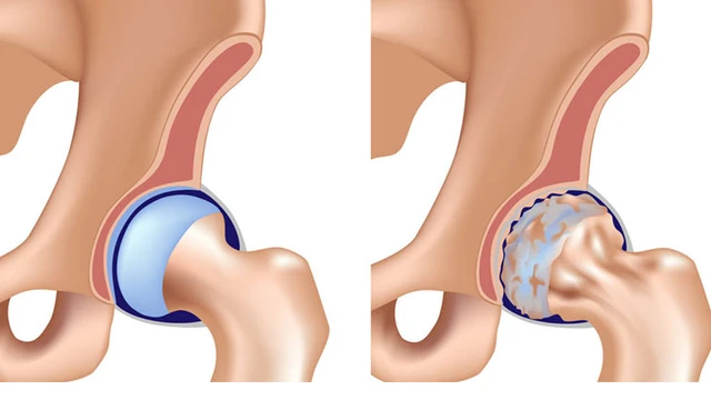 bai-viet/avn-la-gi-nguyen-nhan-va-cach-dieu-tri-can-benh-nay.html