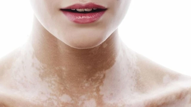 bai-viet/bach-bien-va-lang-ben-khac-nhau-o-diem-nao.html