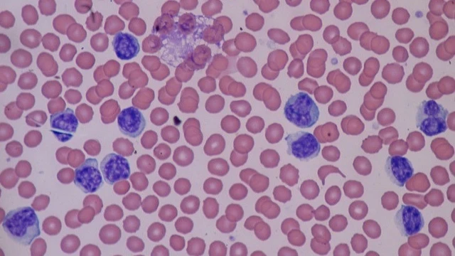 bai-viet/bach-cau-lympho-giam-co-nguy-hiem-khong.html