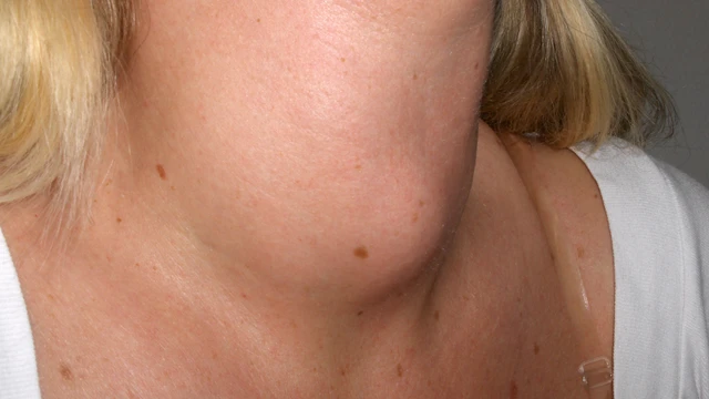 bai-viet/10-dau-hieu-benh-tuyen-giap-o-nu-pho-bien-chi-em-can-biet.html