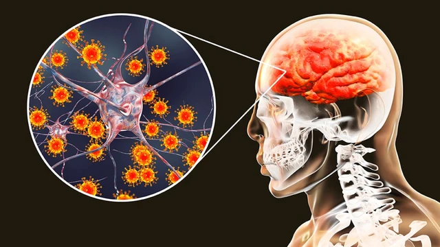 bai-viet/viem-nao-nhat-ban-co-lay-khong-lay-qua-duong-nao-va-cach-phong-benh.html